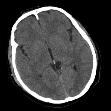 brain scan